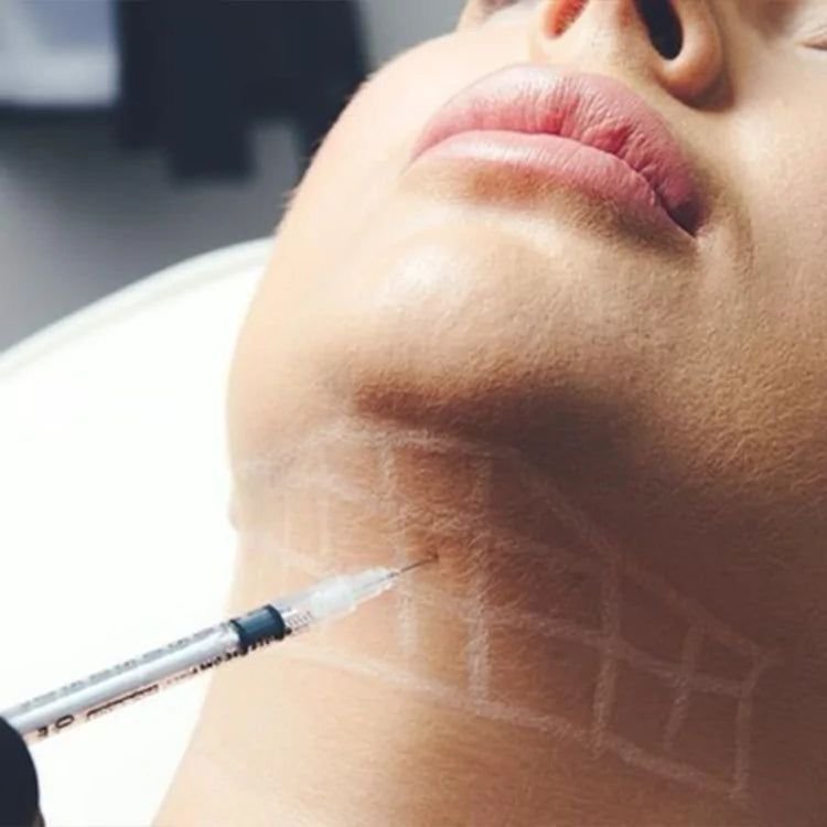 PEELING QUIMICO